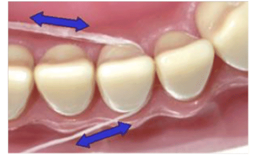 Step 5 in successfully flossing your teeth, Worceter Dental Care