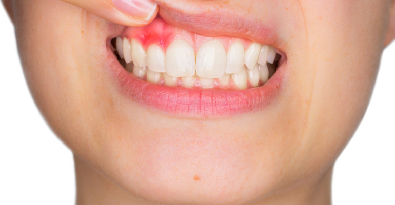 5 Ways to Avoid Gum Disease