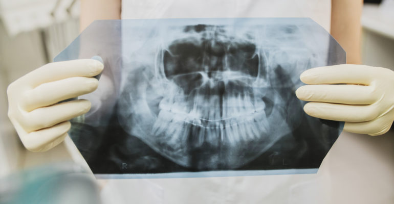 Wisdom Teeth: What You Need to Know