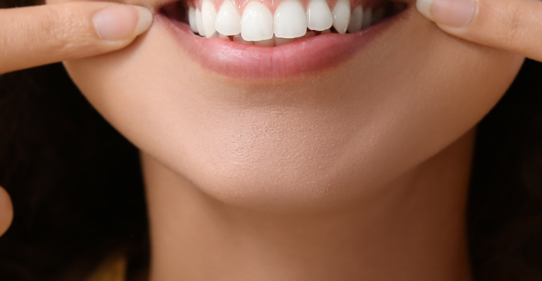 dental veneers | woman smiling
