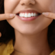 dental veneers | woman smiling