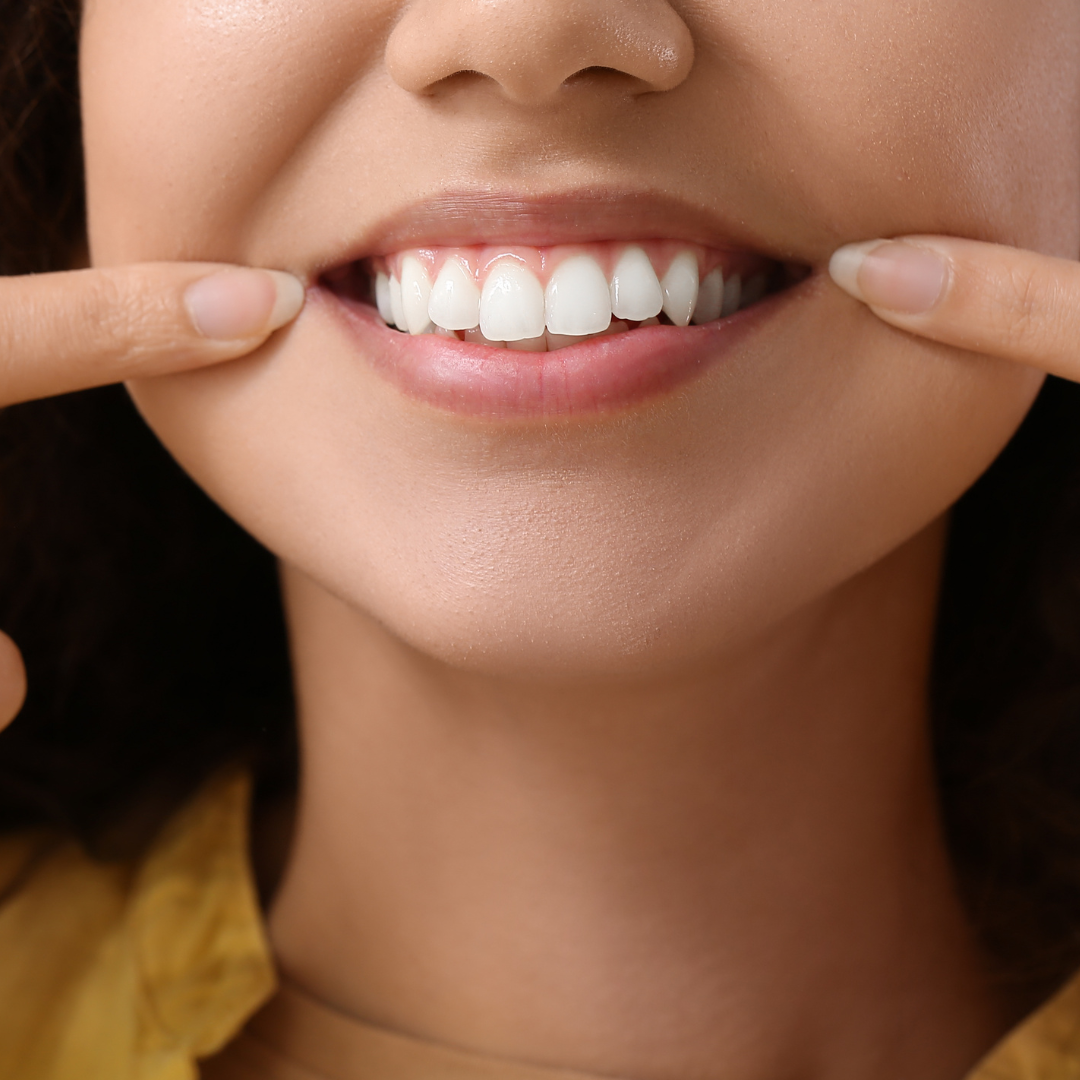 Dental Veneers Are They Right For Your Smile Learn More Today