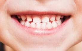 dental sealants